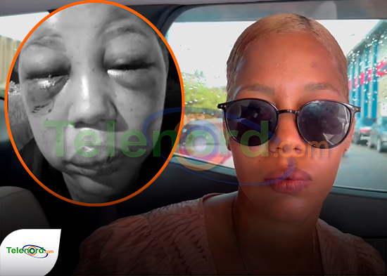Mujer denuncia que su ex pareja le propino una brutal golpiza en SFM