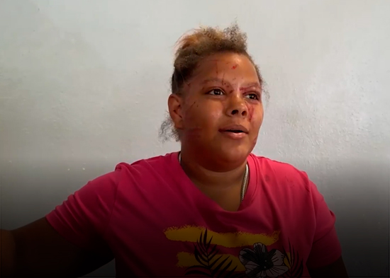 Violenta riña entre vecinas en SFM deja a una mujer con lesiones en el rostro